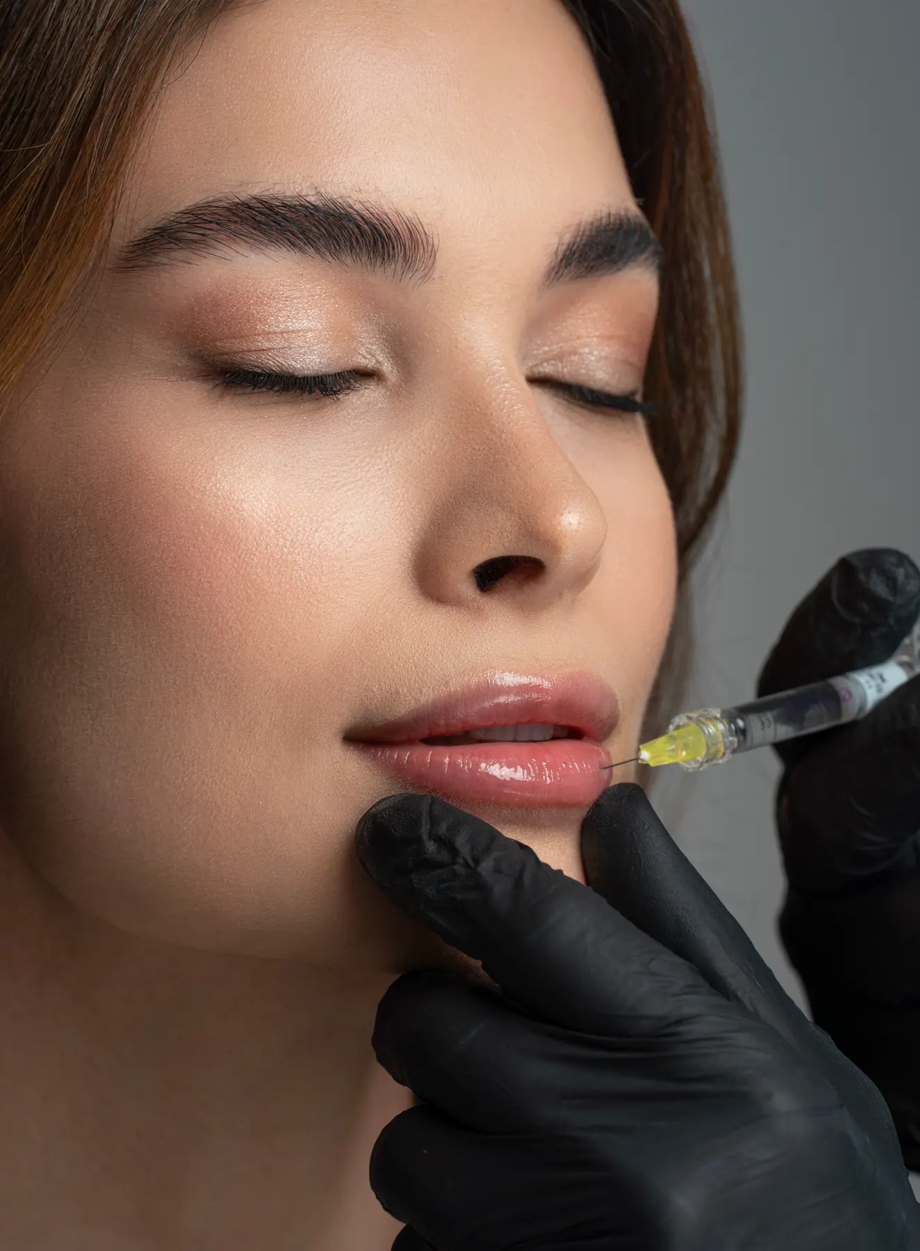 Lip filler treatment detail at Elite Smiles