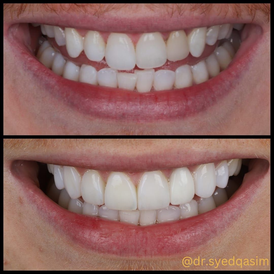 Smile makeover case image 2